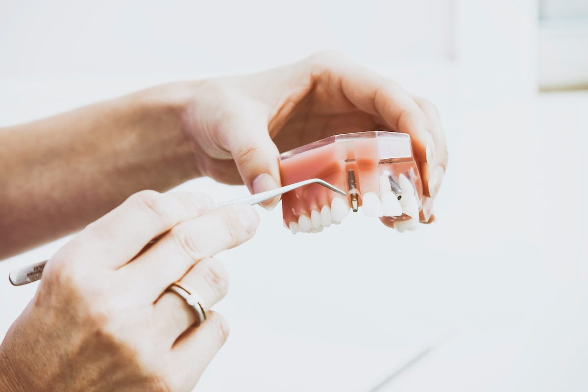 Ką verta žinoti apie dantų implantų priežiūrą?